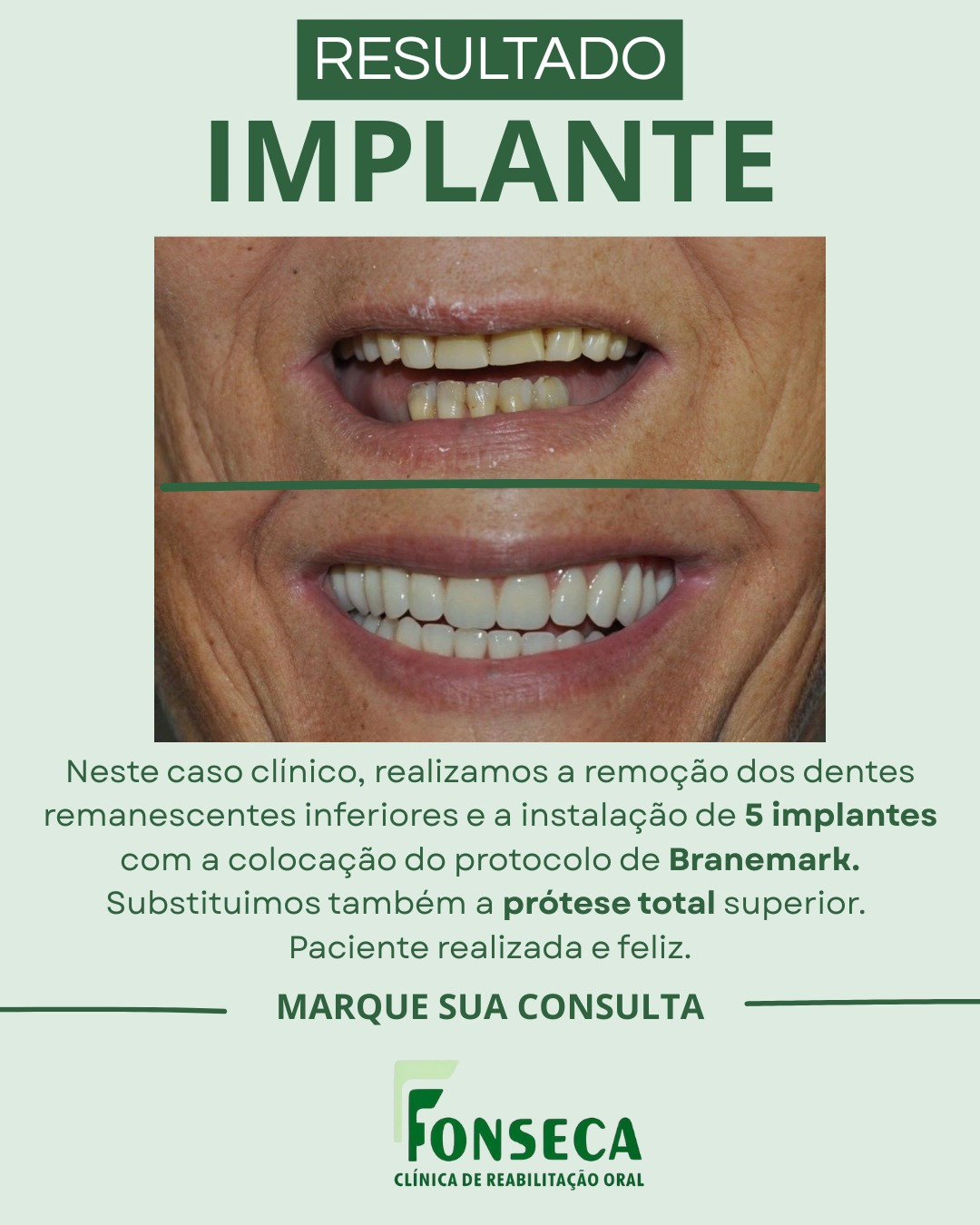 Resultado de implante: antes e depois do sorriso da paciente